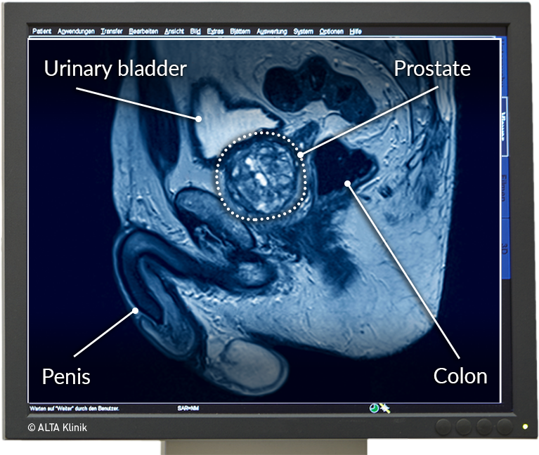 Ejakulation prostata Ejaculation and