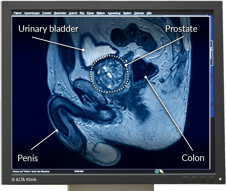 prostata anatomie mrt)