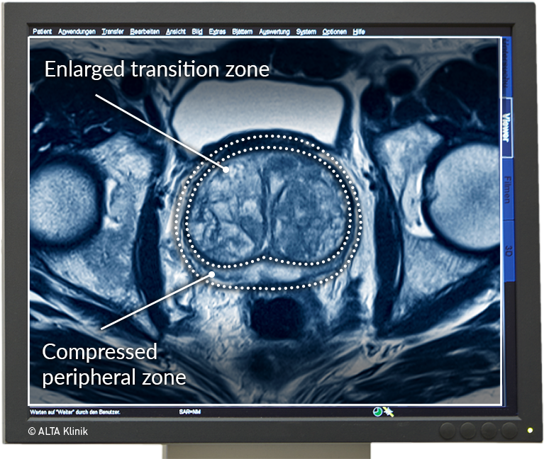 benign prostatic hyperplasia radiology