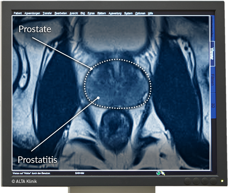radiografia prostatitei