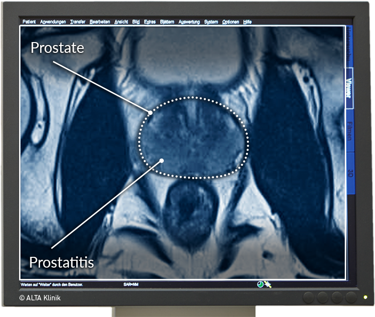 acute prostatitis mri findings