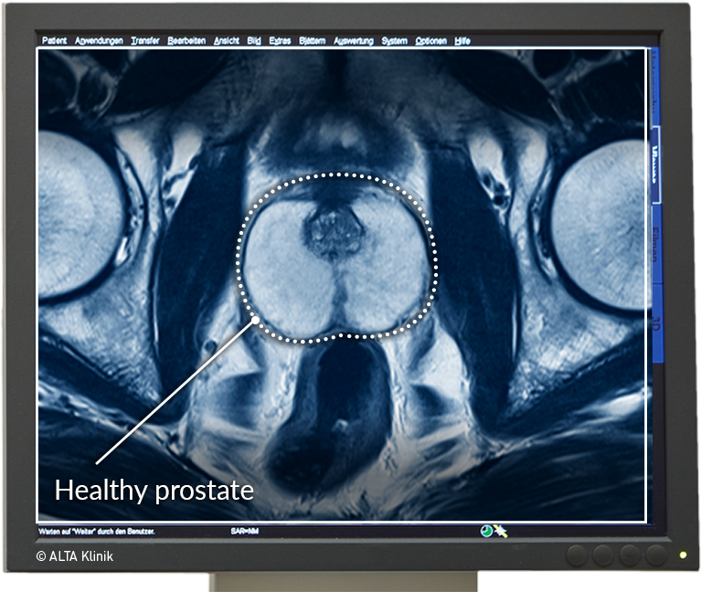 normal prostate mri infectie urinara cu e coli