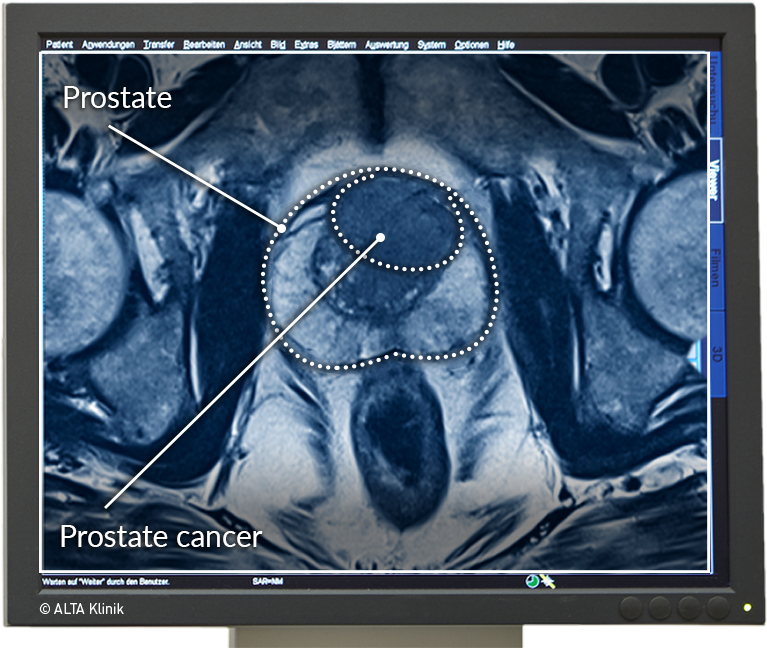 prostate mri)