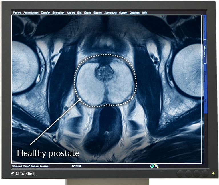 chronic prostatitis mri radiology