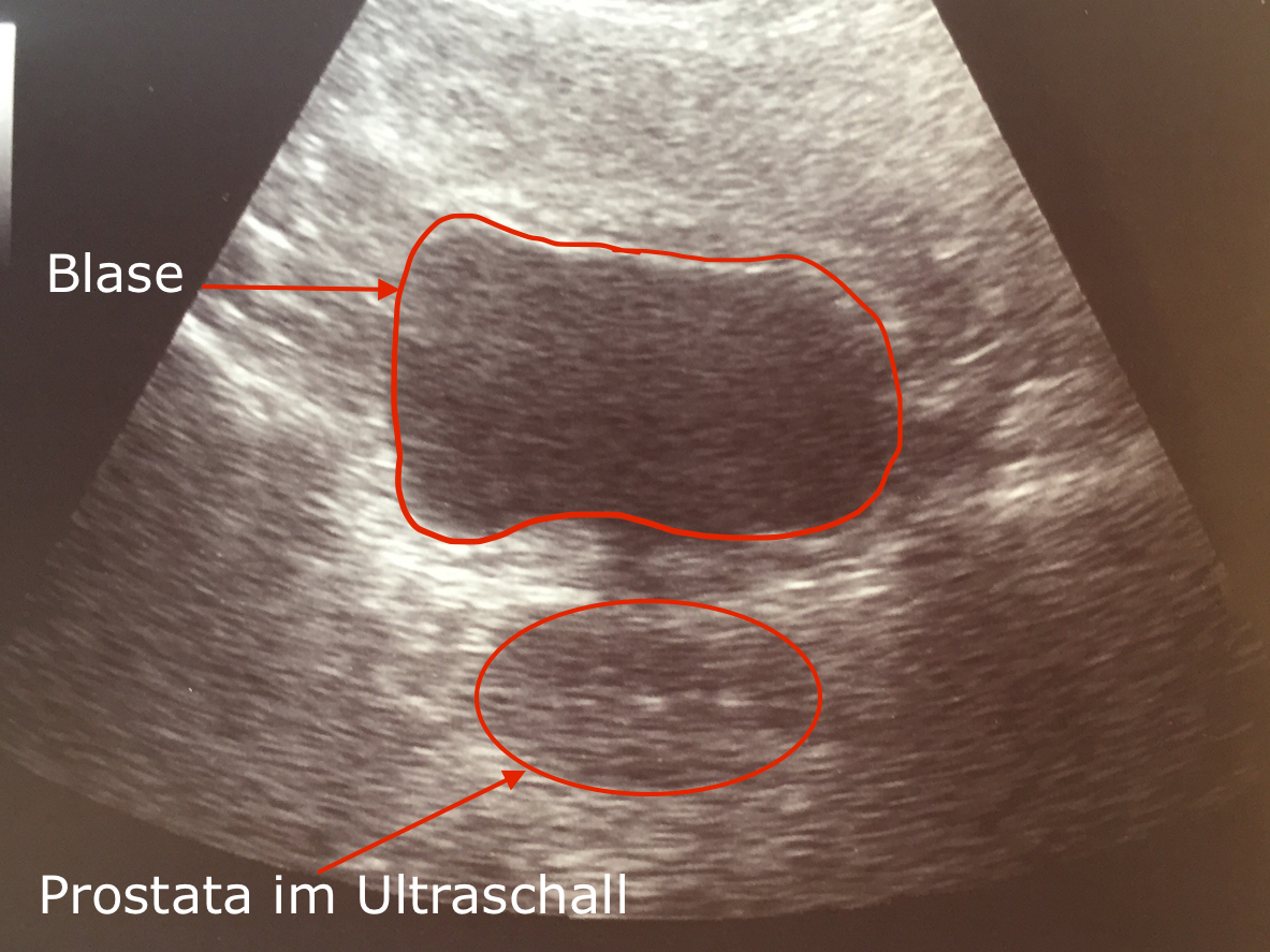 echo italok prosztata hyperplasia