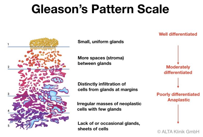 gleason 54= 9 prostate cancer